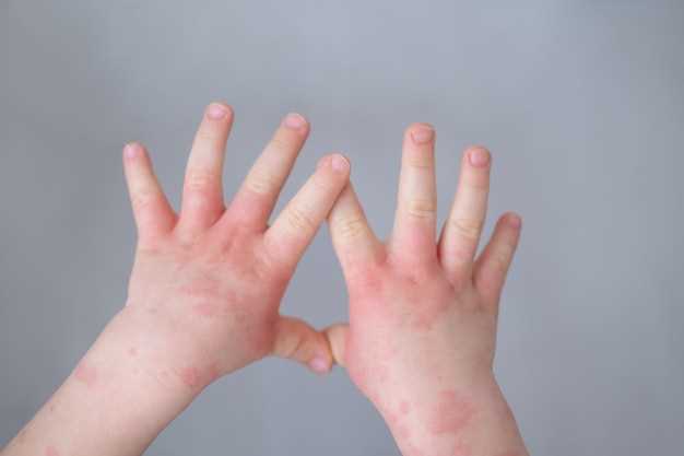 Симптомы кандидоза кожи у детей